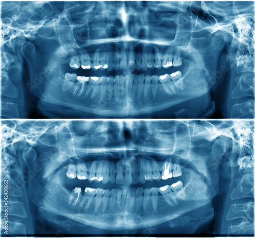 Dental x-rays of the same person at different times