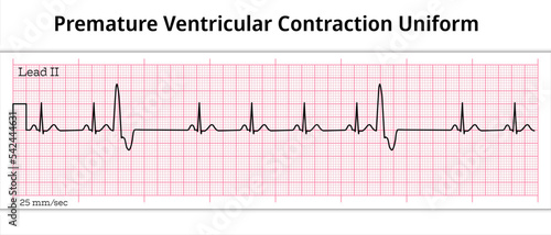ECG Premature Ventricular Contraction Uniform - Unifocal - 8 Second ECG Paper - Ventricular Extrasystole