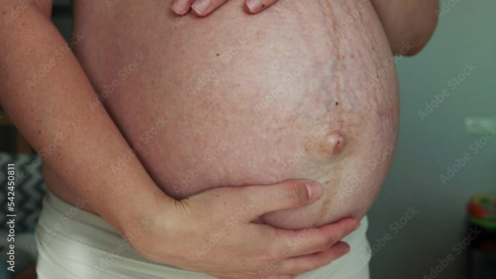 A large belly with stretch marks on the skin and a bulging navel in a pregnant girl in the last month of pregnancy. Maternal health, motherhood. Natural childbirth or caesarean section. Close-up A large belly with stretch marks on the skin and a bulging navel in a pregnant girl in the last month of pregnancy. Maternal health, motherhood. Natural childbirth or caesarean section. Close-up