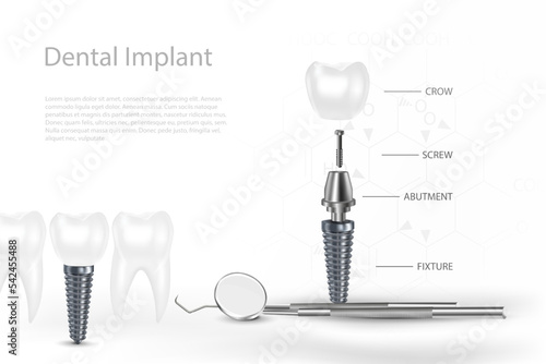 3D Dental Implants Surgery Concept with Tool.