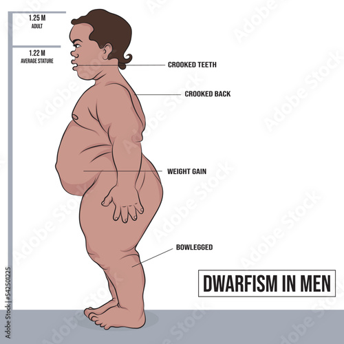 Dwarfism and achondroplasia in men, bone dysplasia caused by a genetic disorder.