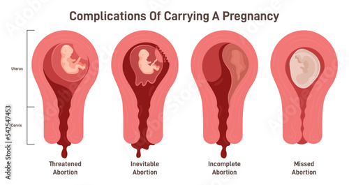 Complications of carrying a pregnancy. Miscarriage danger, separation