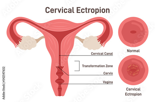 Cervical ectropion or erosion. Cervical canal cells extend on to the surface photo