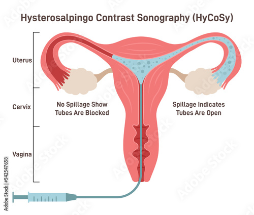 Hysterosalpingo contrast sonography. Comprehensive examination of female