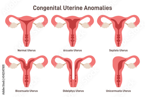 Congenital uterine anomalies set. Female reproductive system medical