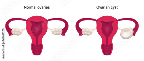 Ovarian cyst. Comparison of normal ovaries and cystic ovaries. Female reproductive system.