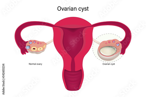 Ovarian cyst with female reproductive system. Female ovarian disease vector.