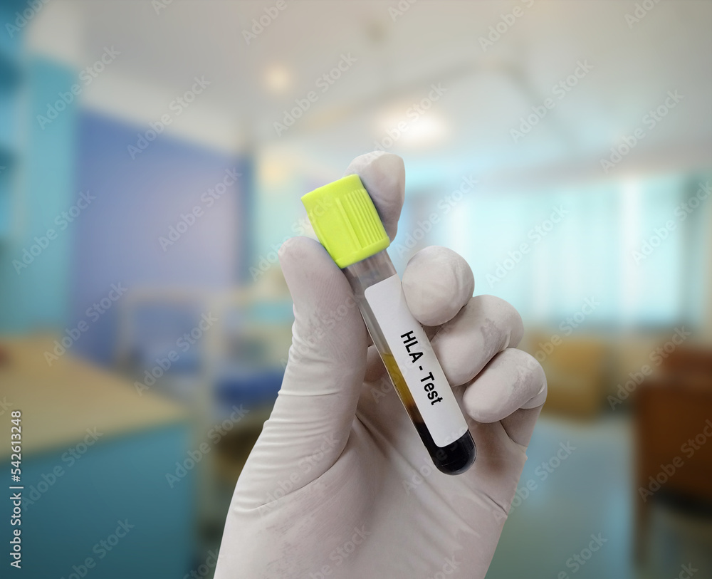 Scientist holds blood sample for HLA (Human Leukocyte Antigen) test with patient bed background.