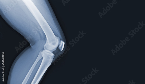 Film x-ray of human knee normal joints and ligaments Medical image concept.