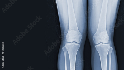 Film x-ray of human both knee standing views normal joints and ligaments Medical image concept.