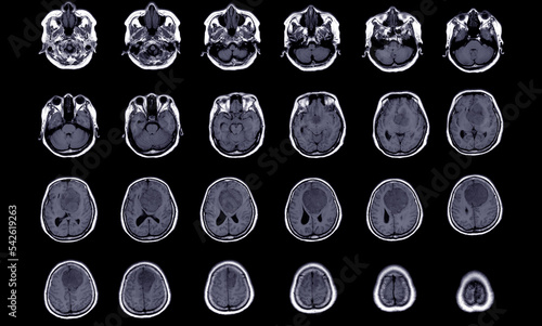 MRI BRAIN Finding of meningioma arising from anterior falx cerebri, extending to bilateral frontal regions, with adjacent minimal perilesional edema at the left frontal lobes, Medical image concept.