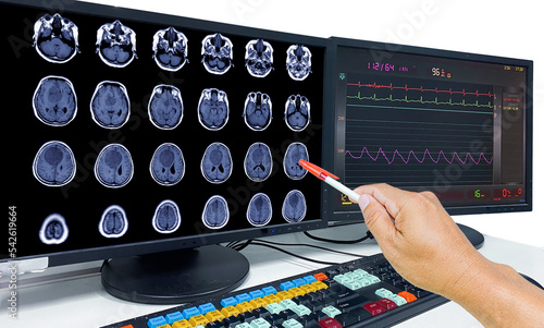 Glioblastoma, Brain metastasis,MRI Brain The doctor pointed out the location of the brain tumor on the computer screen. photo