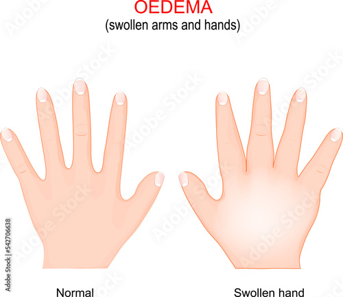 Edema. Swollen arms and hands. oedema