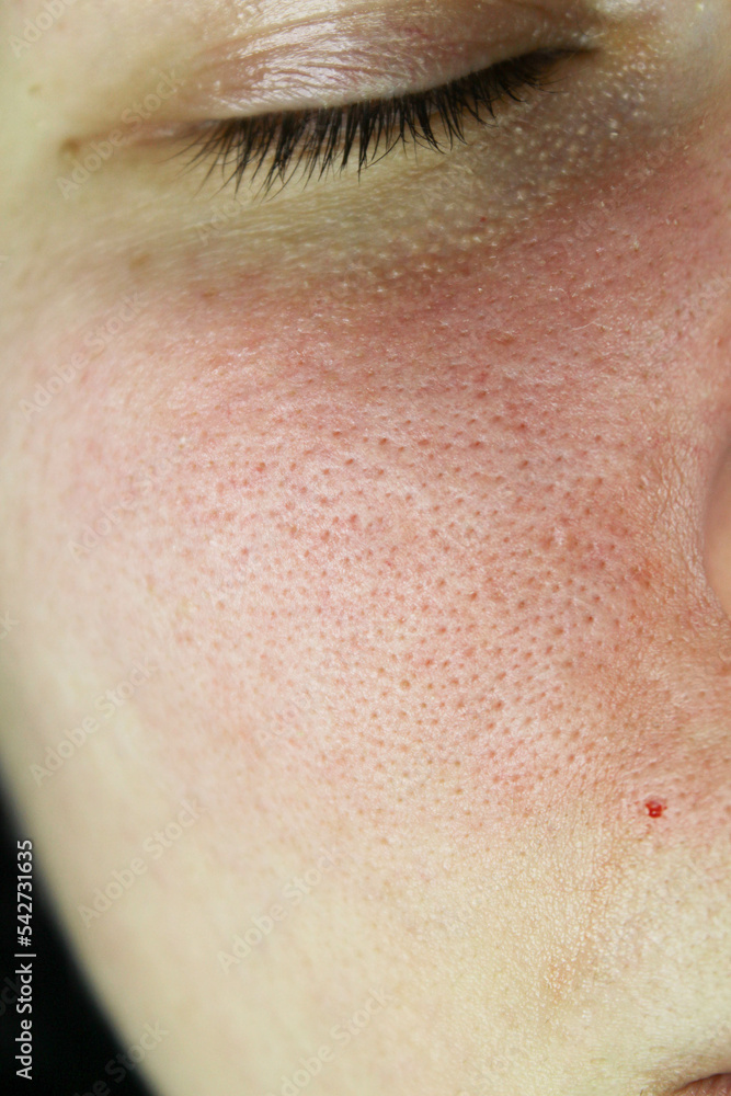 Fototapeta premium cosmetology. facial skin pollution disappears. clogged sebaceous glands on the face. preparation for cleaning the skin at the beautician. facial pores, facial acne, acne treatment and comedone.
