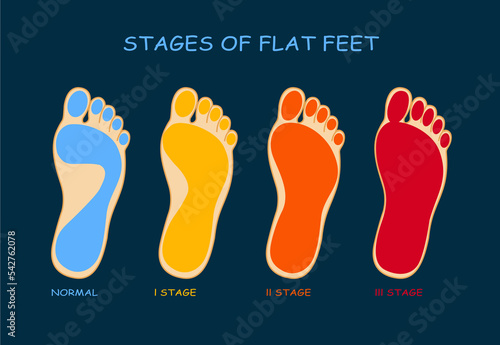 Stages of flat feet. Deformation of the foot. 