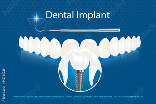 Vector 3d realistic white dental implant on blue background with beautiful teeth mockup. implant model with thread and inscription.