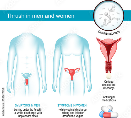 Thrush in men and women. yeast infection. photo