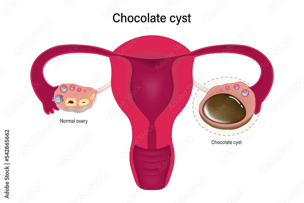 Chocolate cyst. Female ovarian disease vector. Ovarian cyst with female
