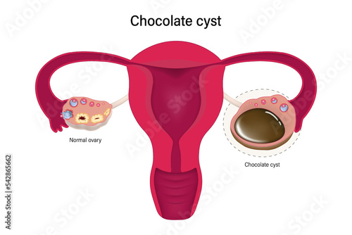 Chocolate cyst. Female ovarian disease vector. Ovarian cyst with female reproductive system. photo