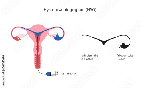 Hysterosalpingogram clinical test of the uterine tubes blockage. 
