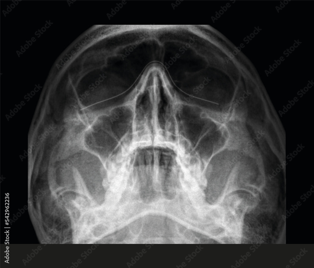 Face x-ray. Radiography below view of a womans face Face x-ray. Radiography below view of a womans face
