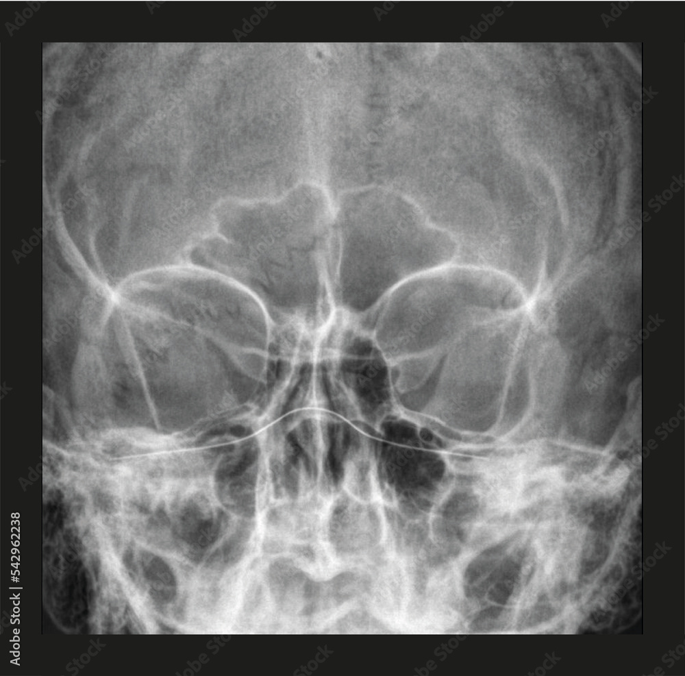 Face x-ray. Radiography frontal view of a womans face
