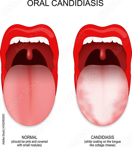 oral candidiasis. healthy mouth and tongue with fungal infection.