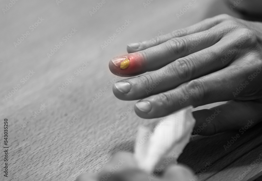 Paronychia, swollen finger with fingernail bed inflammation due to