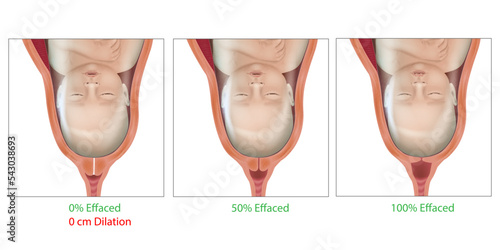 Cervical Effacement and Dilation During Delivery. Cervix, Labor or delivery. Cervix changes from not effaced and dilated to fully effaced and totally. Effaced 0, 50,100