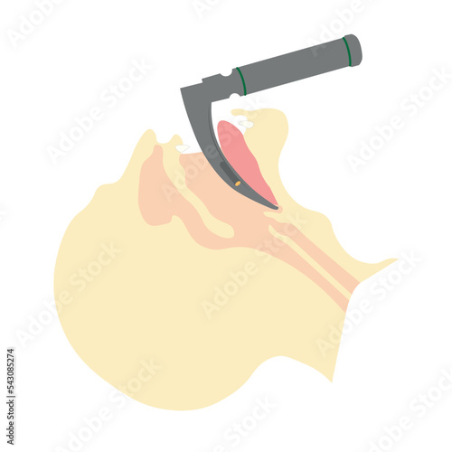 Airway managment illustration. Intubation with laryngoscopy. 