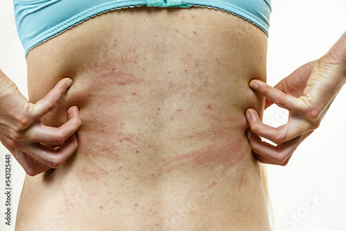 Woman scratching her itchy back with allergy rash photo