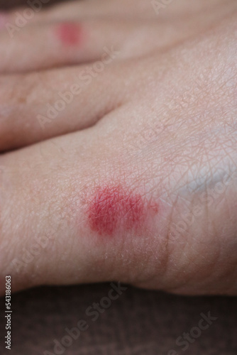 Red inflammation from damage to human skin after an insect bite. An ant bite to the skin of the foot.