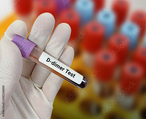 Lab Technologist holds blood sample for 
D dimer test. Corona patient monitoring test with laboratory background.