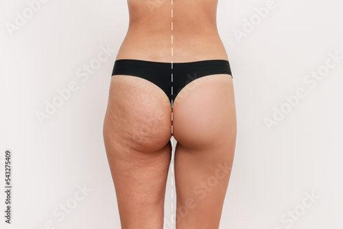 Young woman's thighs and buttocks with cellulite before and after treatment isolated on white background. Getting rid of excess weight. Result of diet, sports. Improving the skin on legs photo