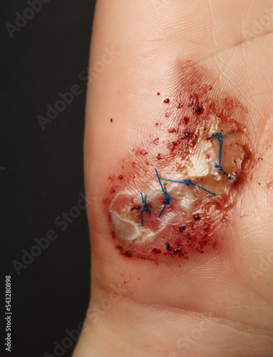 Fotografi Stitched hand laceration after fall