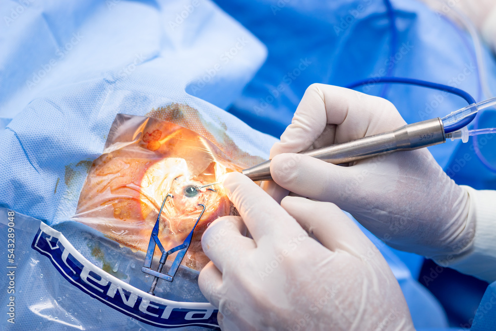 Phacoemulsification, destruction of the opaque lens by ultrasound