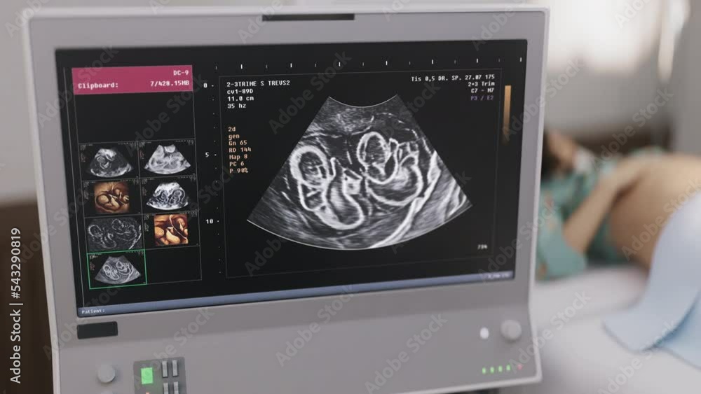 Xray Pregnancy Scan Reveals Twin Babies. Using Modern Medical Xray