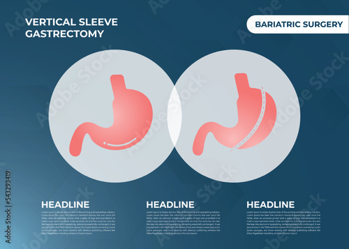 Laparoscopic Sleeve Gastrectomy, Vertical Gastrectomy, Weight loss surgery Vector Illustration of Stomach reduction surgery

