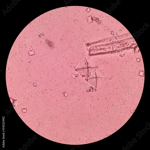 Urine sediment showing Struvite  and Calcium oxalate dihydrate crystals. Triple phosphate renal calculi are formed as a result of urinary tract infection by urease-forming organisms.