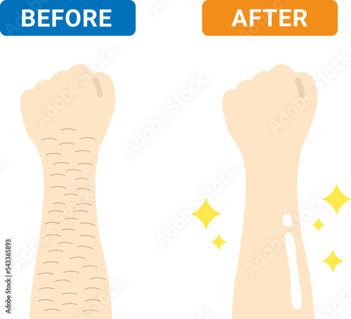 腕を脱毛した人の、ビフォーアフターのイラスト