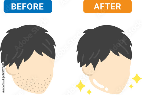 髭を脱毛した男性の、ビフォーアフターのイラスト