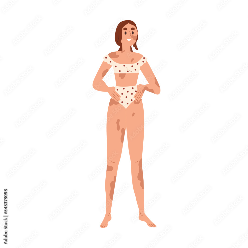 Happy woman with vitiligo. Young girl with pigmentation on face and body, patchy skin with spots. Smiling female wearing bikini swimwear. Flat vector illustration isolated on white background Happy woman with vitiligo. Young girl with pigmentation on face and body, patchy skin with spots. Smiling female wearing bikini swimwear. Flat vector illustration isolated on white background