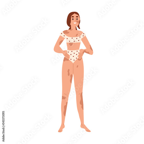 Happy woman with vitiligo. Young girl with pigmentation on face and body, patchy skin with spots. Smiling female wearing bikini swimwear. Flat vector illustration isolated on white background
