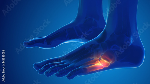 Broken foot bone pain medical concept