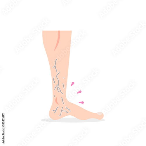 Varicose veins. the appearance of veins in the legs. Blood clotting. health problems. illustration concept design