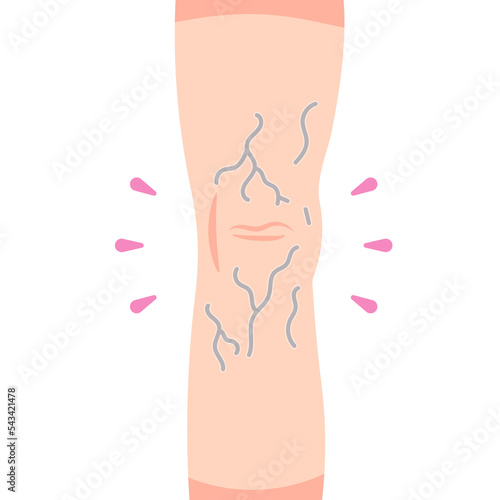 Varicose veins. The appearance of veins behind the knee. Blood clotting. health problems. illustration concept design