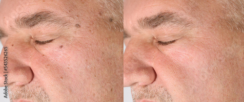 Comparison before and after skin laser treatment black spot on human. Melanoma is a type of skin cancer develops on human skin from the pigment-producing cells melanocytes. Risk to be skin cancer. photo