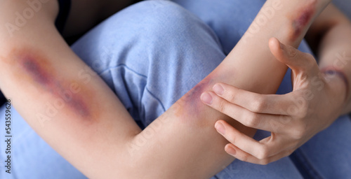 Young woman with bruised arms, closeup