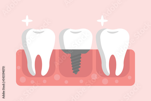 Teeth with dental implant inserted into gum. vector illustration