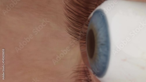Keratoconus of the eye. Curvature of the cornea in the form of a cone, blurred vision, astigmatism. Macro close-up of the growth and curvature of keratoconus motion video. High quality 4k footage photo